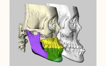 Cirurgia ortognática com planejamento virtual