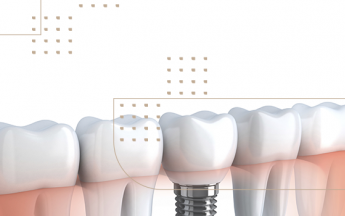 Implantes zigomáticos