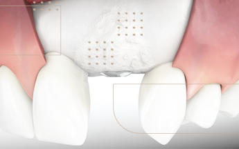 Cirurgia de enxerto ósseo